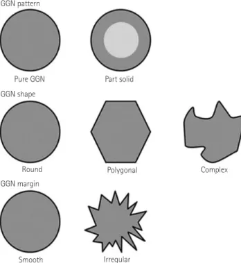 Fig. 1. The classification of ground-glass nodule (GGN): two GGN pat- pat-terns, three GGN shapes and two GGN margins.