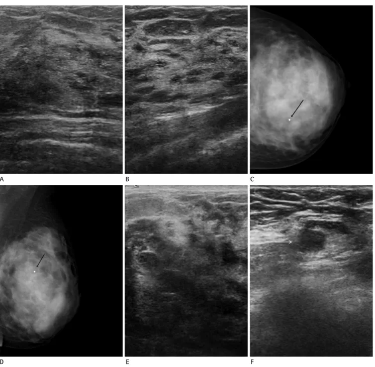 Fig. 1. A 26-year-old female with a palpable lump in the left breast.