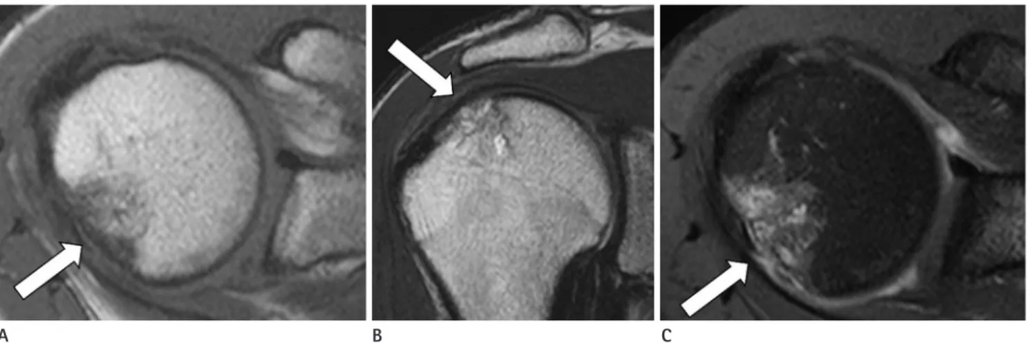 Fig. 3. Magnetic resonance images show irregular low signal intensity on T1-weighted images (A, arrow; T1WI; axial plane; TR/TE, 600/20 ms),  mixed low and high signal intensities on T2-weighted images (B, arrow; T2WI; coronal plane; TR/TE, 4400/80 ms) and