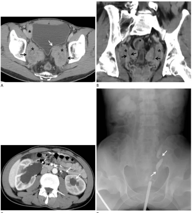 Fig. 1. A 50-year-old man with multi-organ involvement of IgG4-related inflammatory pseudotumor of the urogenital tract
