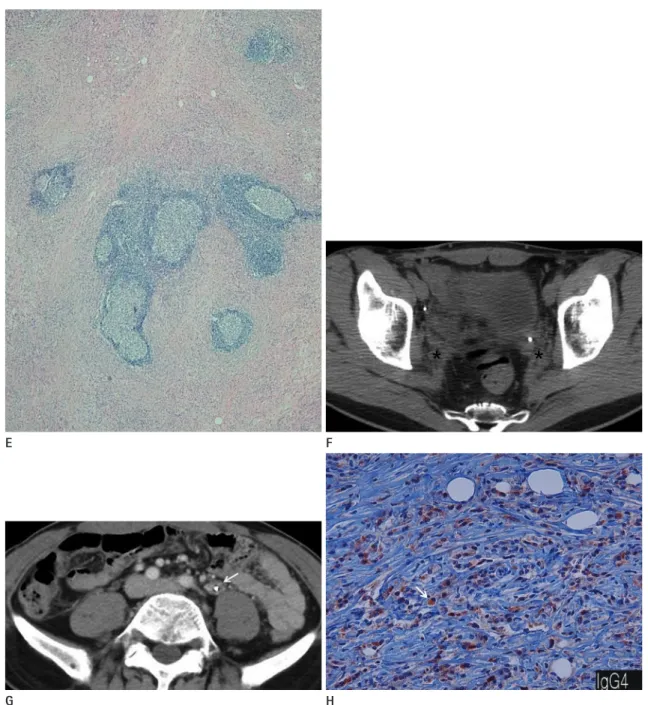 Fig. 1. A 50-year-old man with multi-organ involvement of IgG4-related inflammatory pseudotumor of the urogenital tract