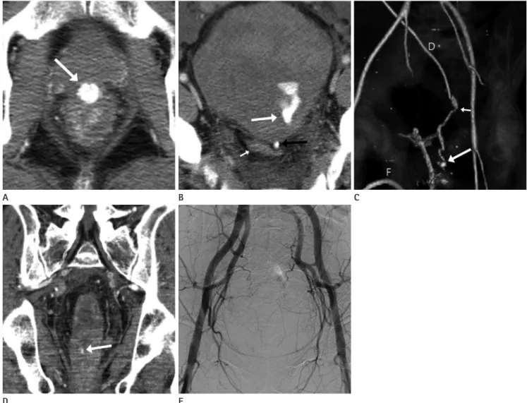 Fig. 1. Traumatic pseudoaneurysm of superior rectal artery in a 43-year-old male patient.