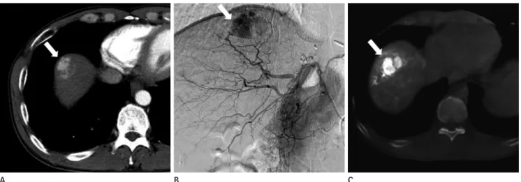 Fig. 2. Coronal images from sequential chest CT performed twelve (A), sixteen (B), and seventeen (C) weeks after TACE