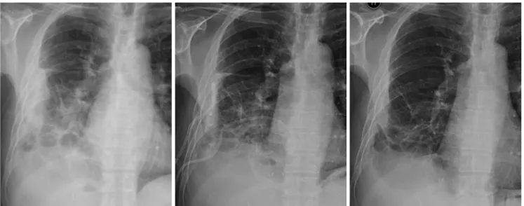 Fig. 3. Sequential plain radiographs of the chest demonstrating gradual resolution of pleural empyema following percutaneous drainage and  antibiotic therapy.