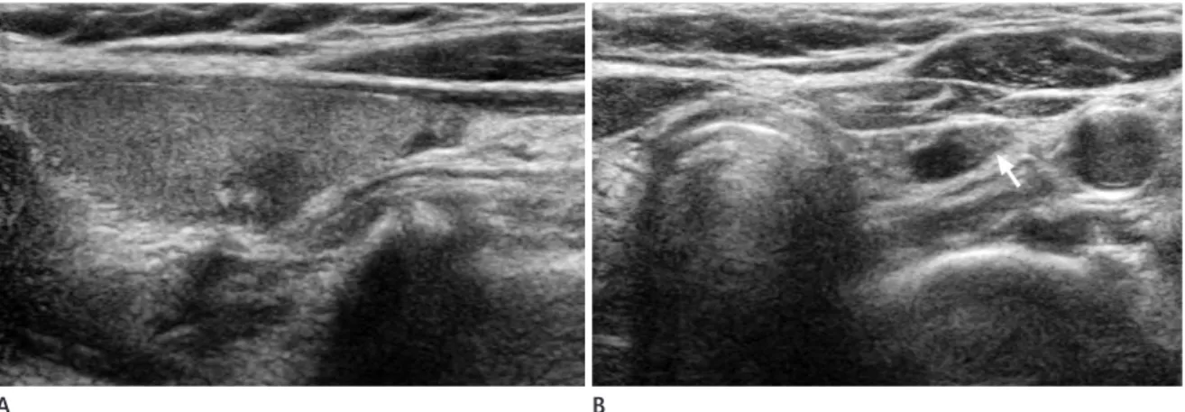 Fig. 2. Central neck node metastasis in 56-year-old man.