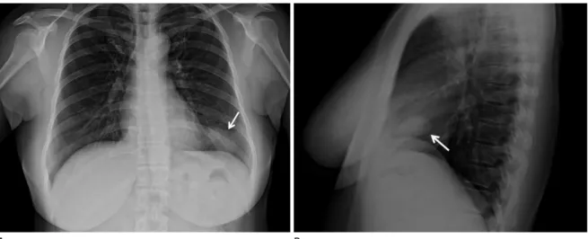 Fig. 1. Plain chest X-ray of the calcifying fibrous tumor of the pleura. Chest PA (A) and lateral view (B) show a 3 × 4.5 cm, oval- oval-shaped, well-circumscribed mass-like lesion (arrow) in the left lower lung periphery.