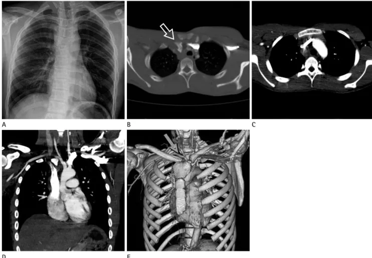 Fig. 1. Posterior sternoclavicular dislocation in 16-year-old man.