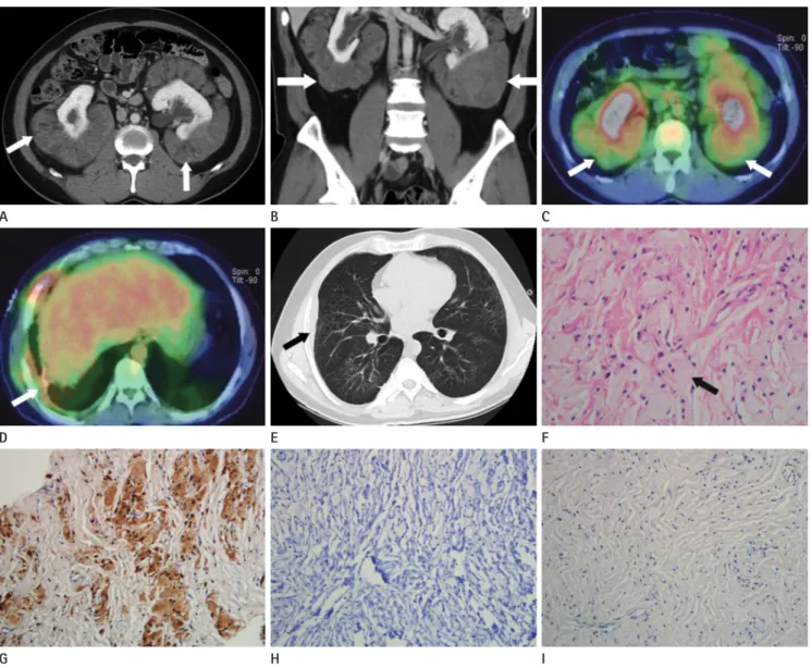 Fig. 1. A 40-year-old man with Erdheim-Chester disease. Bilateral perirenal masses with faint fat tissue (white arrows) are revealed on axial im- im-ages (A) and coronal image of abdominal CT (B)