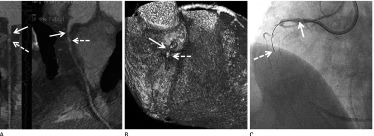 Fig. 1. A 54-year-old male with chronic total occlusion in right coronary artery (RCA) and procedure by parallel wire technique