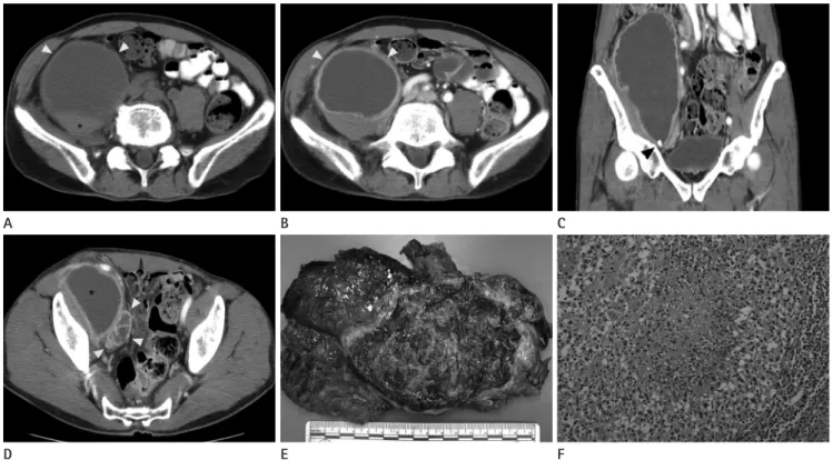 Fig. 1. Oval-shaped cystic mass in the right lower retroperitoneal space.