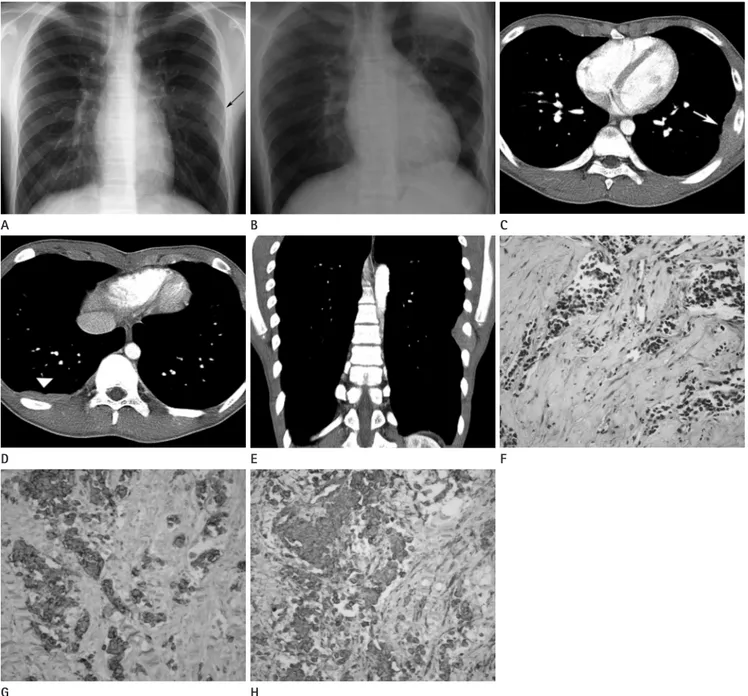 Fig. 1. Chest radiographs (A, B), chest CT (C-E), and microscopic features (F-H) of desmoplastic small round cell tumor in a 15-year-old male.