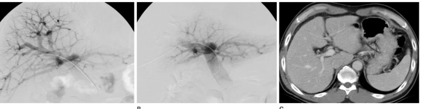 Fig. 1. A 45-year-old man with a hepatocellular carcinoma underwent preoperative portal vein embolization using only gelfoam