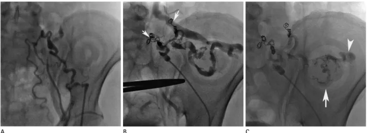 Fig. 2. Varix and inflow veins are not visualized due to collateral competing veins at the initial venogram (A)
