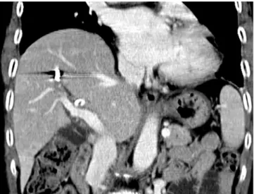 Fig. 2. Fluoroscopy following hepatic arteriography revealed irregular  cast-like filling defects (arrows) in the bile duct due to massive  hemo-bilia.