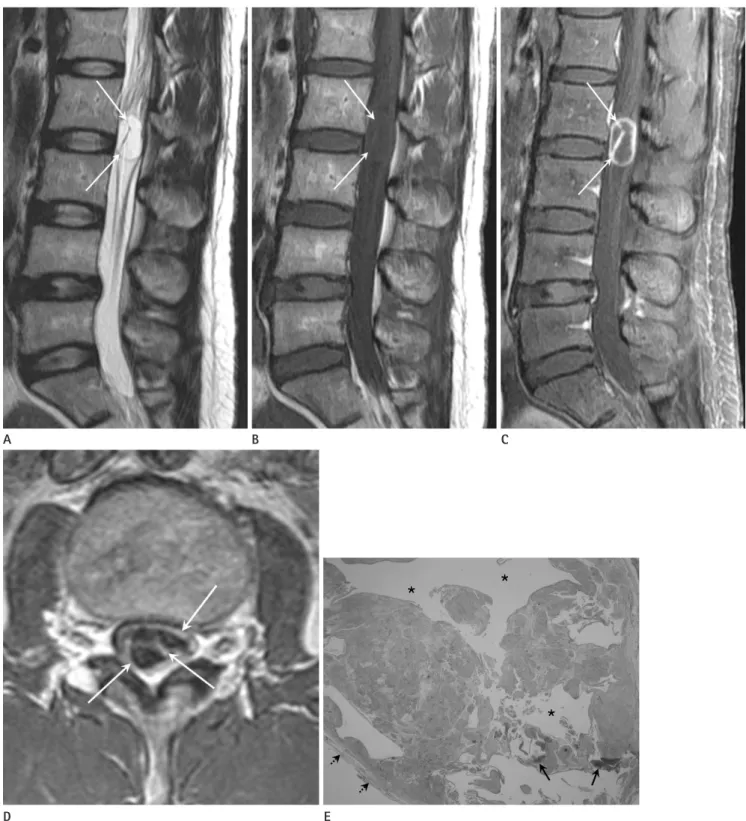 Fig. 1. Sagittal images of T2-weighted (A), T1-weighted (B), fat-suppressed contrast-enhanced T1-weighted sequences (C), axial image of con- con-trast-enhanced T1-weighted sequence, and a photograph (E) of pathology in a 49-year-old woman with a spinal int