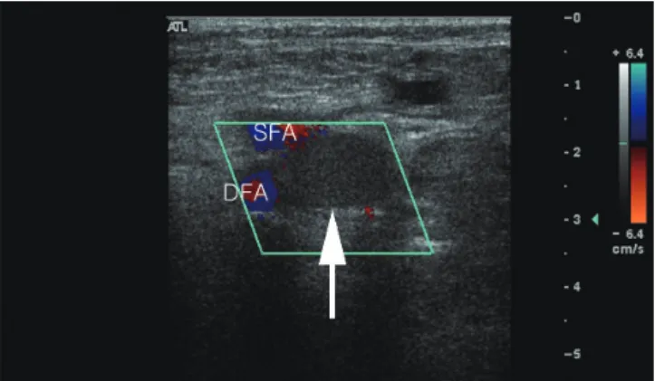 Fig. 3. Ascending venography (prone position) shows extrinsic com- com-pression of the right common femoral vein (white arrow)