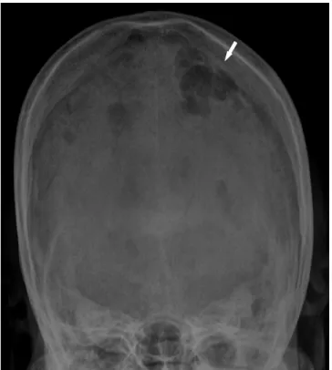 Fig. 2. Coronal image of bone window CT shows a defect of the inner  table, widened diploic space (black arrow)