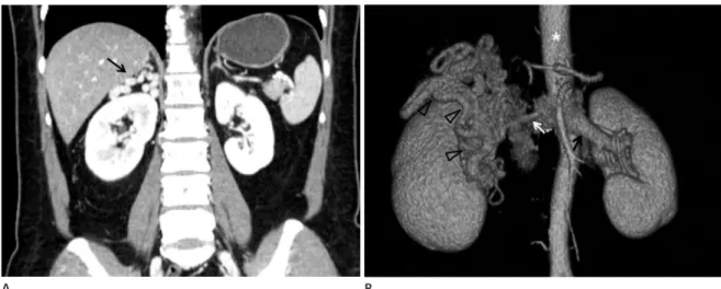 Fig. 1. Coronal reformatted CT image (A) and volume rendered image (B) of the aberrent right renal venous drainage