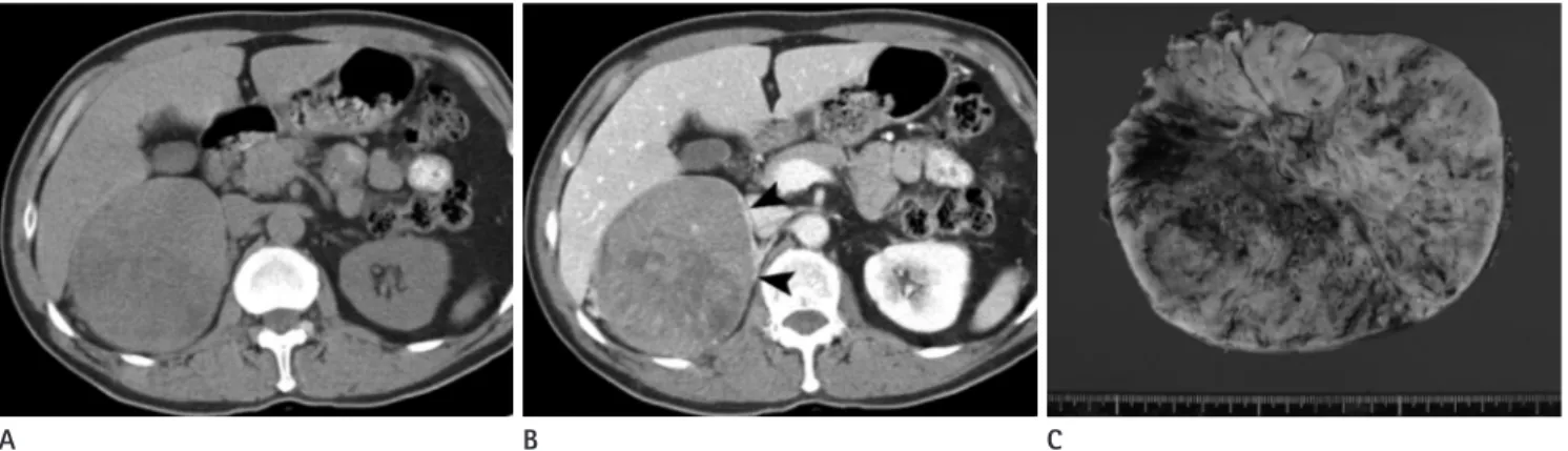 Fig. 2. A 63-year-old man presenting a right adrenal gland mass. 