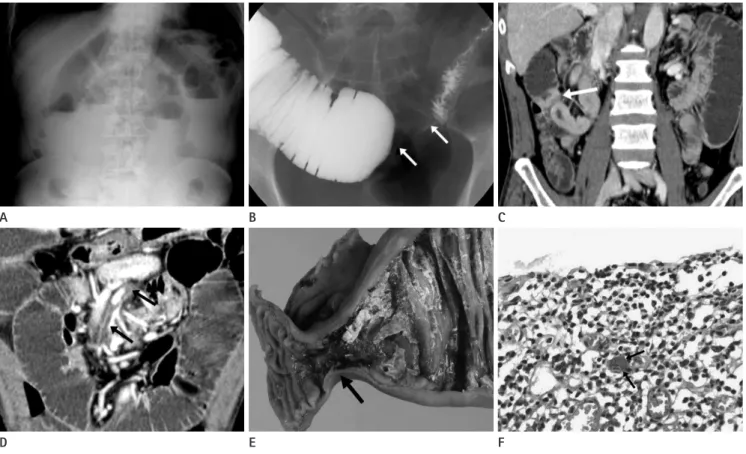 Fig. 1. Partial small bowel obstruction in a 51-year-old man. 