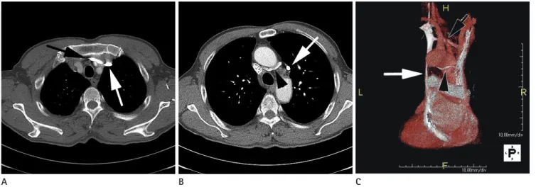 Fig. 1. Double left brachiocephalic veins (BCV) with persistent left superior vena cava (PLSVC) in a 72-year-old male patient