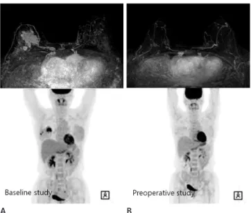Fig.  2. A 47-year-old woman was diagnosed with invasive lobular  carcinoma in the right breast and underwent neoadjuvant  chemo-therapy