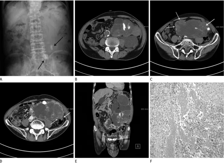 Fig. 1. A 76-year-old man with primary renal osteosarcoma.