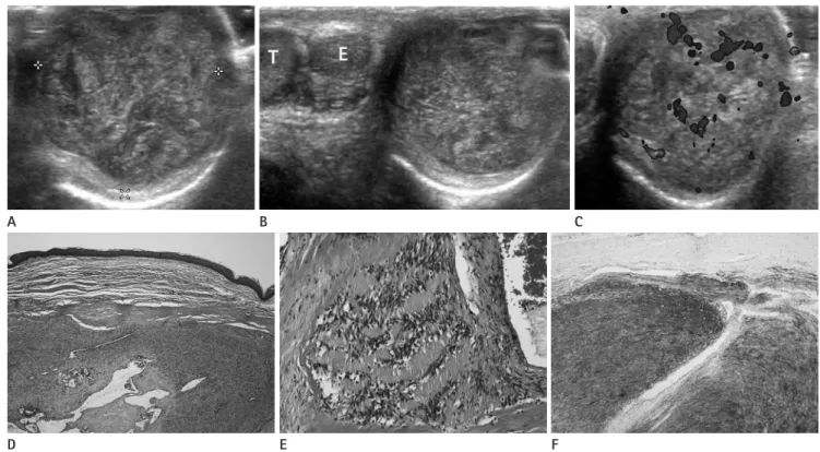 Fig. 1. A 59-year-old man presented with a slowly growing scrotal tumor of duration 10 years.