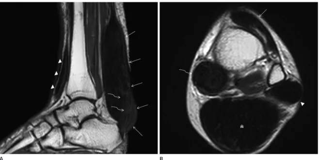 Fig. 4. A 52-year-old woman who presented with multiple soft tissue lesions in both ankles.