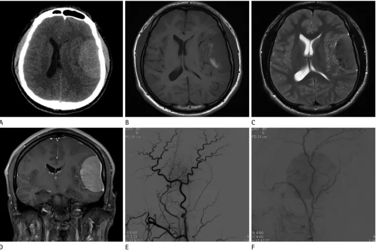 Fig. 1. Radiologic findings of dural anaplastic large cell lymphoma in a 17-year-old man.