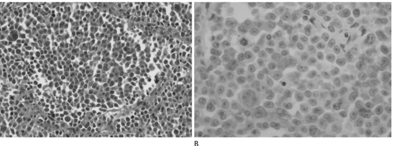 Fig. 2. Microscopic findings of dural anaplastic large cell lymphoma in a 17-year-old man.