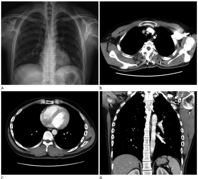 Fig. 1. Chest radiograph (A) shows absence of right serratus muscle shadow compared to the other side showing normal chest  wall with the shadows of serratus anterior, intermuscular fat plane, latissimus dorsi, and subcutaneous fat from medial to  later-al