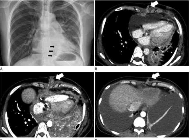 Fig. 1. Chest PA taken immediately after pericardial window operation. Two indwelling chest tubes are inserted via subxiphoid  (arrows) and intercostal routes, respectively (A)