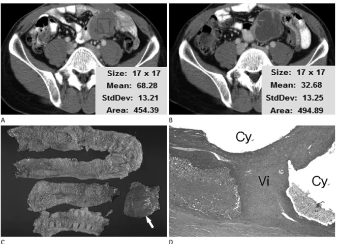 Fig. 1. Transverse CT scans of a gastrointestinal stromal tumor before and after imatinib treatment in a 36-year-old man
