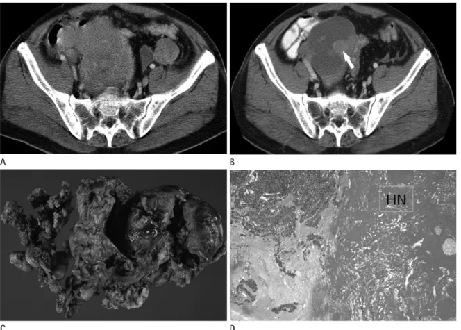 Fig. 2. Transverse CT scans of a primary gastrointestinal stromal tumor (GIST) of the small bowel in a 53-year-old man