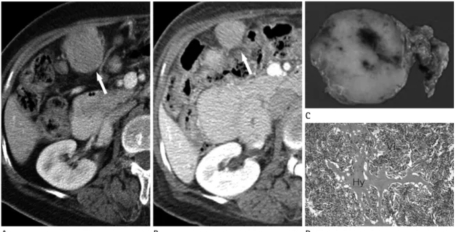 Fig. 5. Transverse CT scans of omental metastasis from gastrointestinal stromal tumor of small bowel in 64-year-old woman