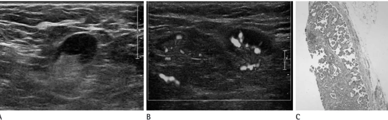 Fig. 5. Ultrasonography and photomicrograph image of the left axillary lymph node.
