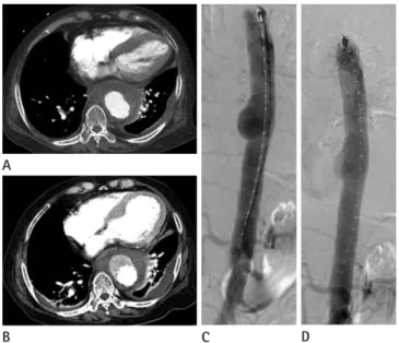 Fig. 1. A-77-year-old woman with thoracic aortic aneurysm.