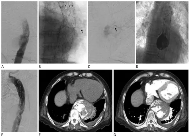 Fig. 3. The diagram shows a 2.0-Fr microcatheter (Progreat; Terumo,  Tokyo, Japan) with a 0.18-inch guide wire (Transend; Boston Scientific,   Boston, MA, USA), advanced into the aneurysmal sac between the  dis-tal end of the stent-graft and the aortic wal