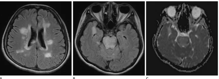 Fig. 1. A 36-year-old female presented with headache. MR images showed hyperintensity involving the periventricular cerebral white matter  (A), pons and cerebellum bilaterally, with the stripe sign in the pons on fluid-attenuated inversion recovery (FLAIR)