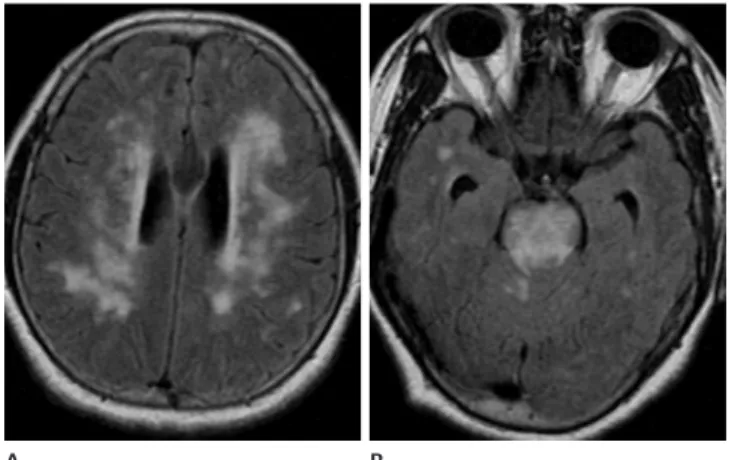 Fig. 2. A 55-year-old female suffered from headache and vomiting. 