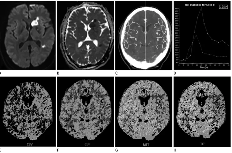 Fig. 1. Locations of regions of interest (ROI) in cerebral perfusion CT.
