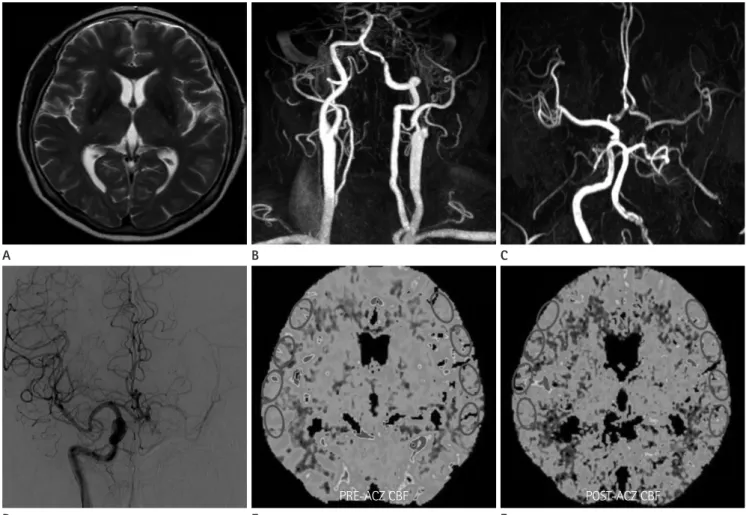 Fig. 3. Percentage change of cerebral blood flow (CBF) in patient with left proximal internal cerebral artery (ICA) occlusion with primary collater- collater-als
