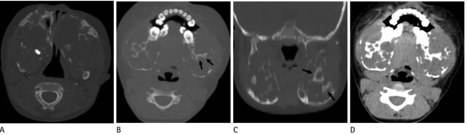 Fig. 1. A panoramic view shows expansile remodeling of the maxilla  and mandible replaced by multilocular osteolytic lesions bilaterally