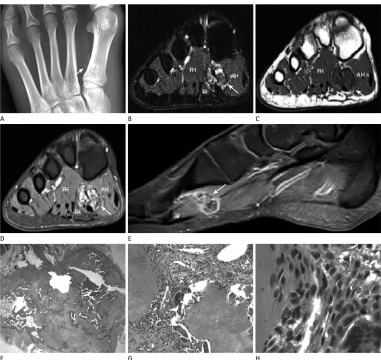 Fig. 1. Giant cell reparative granuloma of soft tissue of foot in 18-year-old woman. 
