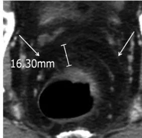 Fig. 1. CT image of a 51-year-old male with T3 rectal cancer and clear  circumferencial resection margin