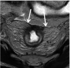 Fig. 2. MR image of a 59-year-old female with T3 rectal cancer and  involved circumferential resection margin