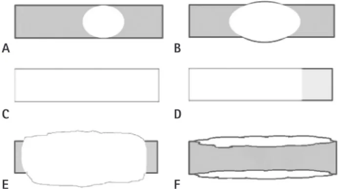 Fig. 1. Illustration of pattern of bone lesions in breast MRI. Focal mass  pattern represents a round or oval mass confined in marrow space (A)  or an expansile mass (B)