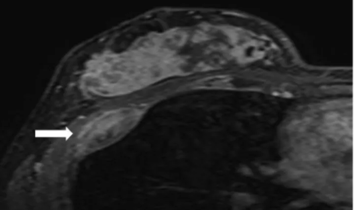 Fig. 3. A 31-year-old female with rib metastasis showing extraosse- extraosse-ous soft tissue change pattern