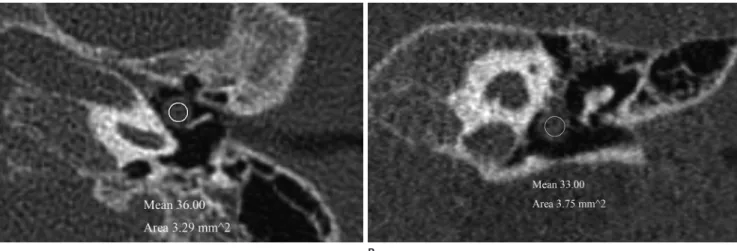 Fig. 1. Congenital cholesteatoma of the left middle ear cavity in a 3-year-old boy. Axial (A) and reformatted coronal (B) temporal bone CT scans  demonstrating a well-defined, round soft-tissue mass in the mesotympanum of the left middle ear cavity